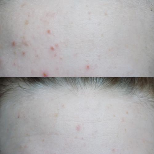 Floslek Balance T-zone, Corrective Cream with AHA & PHA Acids (Krem korygujący z kwasami AHA i PHA) - opinie | zdjęcie do recenzji od ksanaru - 1