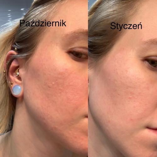 inoPharm Pure Elements, Lifting Serum 2% Retinol (Serum do twarzy z retinolem 2%) - opinie | zdjęcie do recenzji od agacior89 - 1