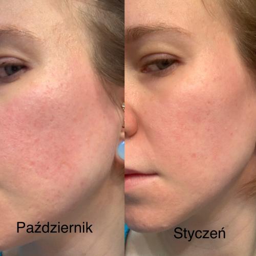 inoPharm Pure Elements, Lifting Serum 2% Retinol (Serum do twarzy z retinolem 2%) - opinie | zdjęcie do recenzji od agacior89 - 2