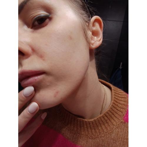Eveline Cosmetics Perfect Skin. Acne, Kuracja na noc korygująca niedoskonałości `10% Complex AHA + BHA + PHA` - opinie | zdjęcie do recenzji od NicoleNiki - 4