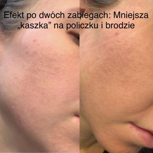 Nacomi Meso Therapy, Meso Wand (Urządzenie do mezoterapii) - opinie | zdjęcie do recenzji od agacior89 - 1