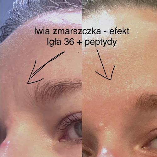 Nacomi Meso Therapy, Meso Wand (Urządzenie do mezoterapii) - opinie | zdjęcie do recenzji od agacior89 - 2