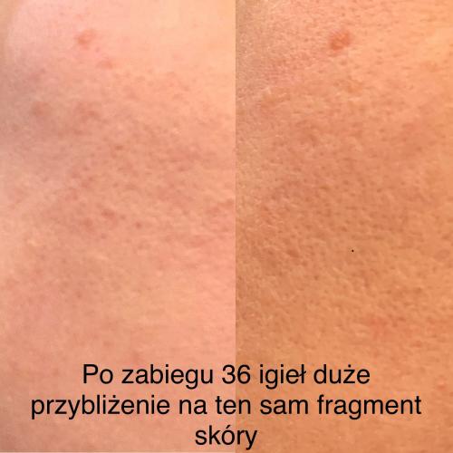 Nacomi Meso Therapy, Meso Wand (Urządzenie do mezoterapii) - opinie | zdjęcie do recenzji od agacior89 - 3