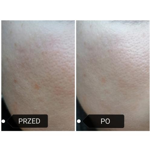L'Oreal Paris Revitalift 5% Glycolic Acid Peeling Toner (Złuszczający tonik z kwasem glikolowym) - opinie | zdjęcie do recenzji od monnie7 - 3